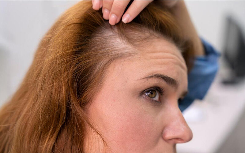 skin-cancer-on-the-scalp