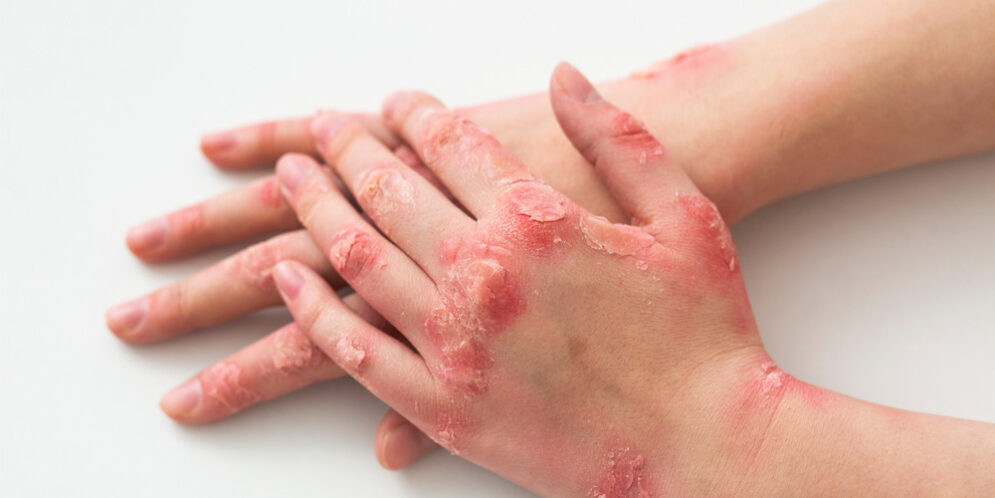 Basal Cell Carcinoma Stages – Skin Cancer